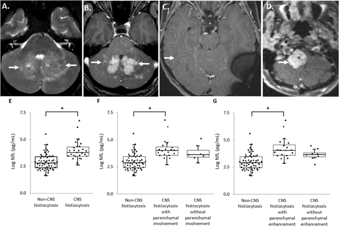 Blood neurofilament light chain measurements in adults with CNS histiocytic neoplasms