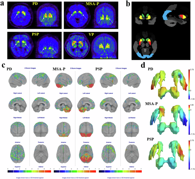 The value of PET/CT in the diagnosis and differential diagnosis of Parkinson’s disease: a dual-tracer study