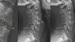 Sagittal morphometry of intervertebral spaces in subaxial cervical region of asymptomatic Chinese.