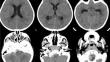 Acute hydrocephalus triggered by isolated traumatic subarachnoid hemorrhage in the posterior fossa following mandibular fracture in a toddler: a rare case report.