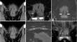 Morphology and arterial supply of the pyramidalis muscle in an Australian female population using computed tomography angiography