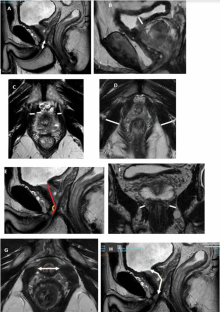 Shorter prostatic urethral length in preoperative Magnetic Resonance Imaging is associated with higher risk of climacturia following robot-assisted laparoscopic radical prostatectomy