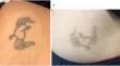 Removal of black tattoos by Picosecond Q-switched Nd-YAG laser in the middle eastern skin type IV: prospective study.