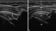 Effects of low-level laser therapy on symptomatic calcific rotator cuff tendinopathy : A prospective randomized controlled study.