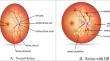 Detection of Diabetic Retinopathy Using Discrete Wavelet-Based Center-Symmetric Local Binary Pattern and Statistical Features.