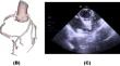 Implications of the cadaveric heart dissection for cardiac electrophysiology and atrial fibrillation ablation: global electrophysiology perspective.