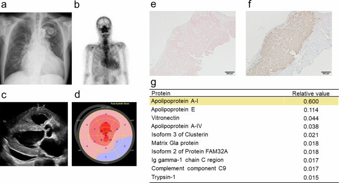 The APOA1 p.Leu202Arg variant potentially causes autosomal recessive cardiac amyloidosis.