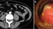 An Unusual Lesion in the Ileocecal Area: Reactive Hyperplasia of Blood Vessels