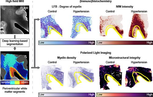 Deep learning-based segmentation in MRI-(immuno)histological examination of myelin and axonal damage in normal-appearing white matter and white matter hyperintensities.