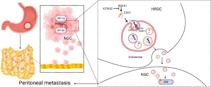 Hypoxia-induced LAMB2-enriched extracellular vesicles promote peritoneal metastasis in gastric cancer via the ROCK1-CAV1-Rab11 axis