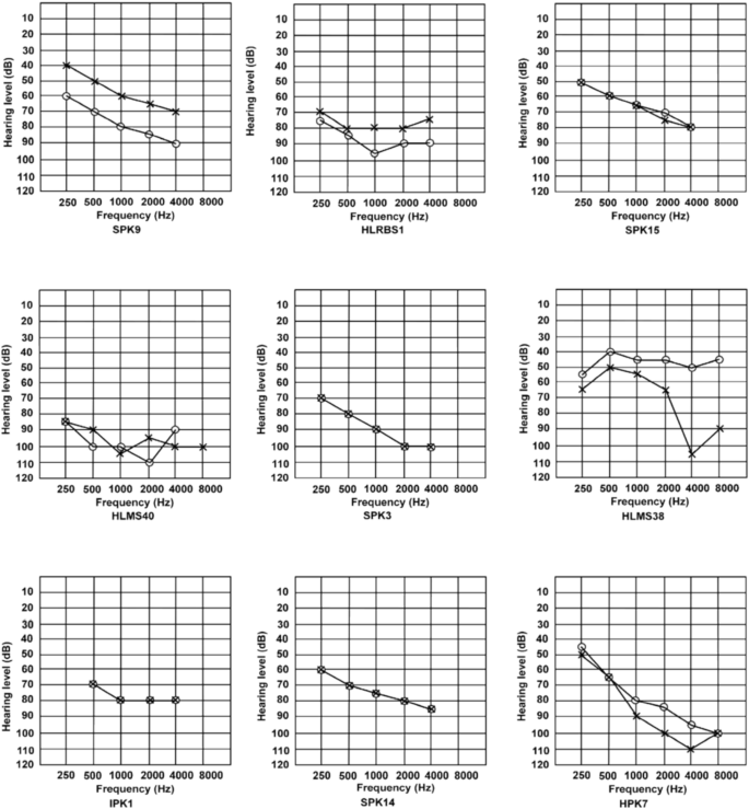 Genetic investigations on singleton school aged children reveal novel variants and new candidate genes for hearing loss