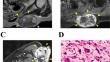 Establishment and characterization of two novel patient-derived cell lines from myxofibrosarcoma: NCC-MFS7-C1 and NCC-MFS8-C1.