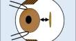 Medial rectus insertion site in cases of acute acquired comitant esotropia associated with excessive digital device usage.