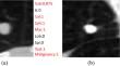 Attribute and Malignancy Analysis of Lung Nodule on Chest CT with Cause-and-Effect Logic