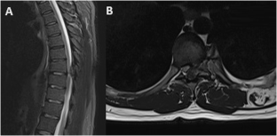 Solitary thoracic spine osteochondroma: a rare cause for spinal cord compression.