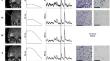 Raman and autofluorescence spectroscopy for in situ identification of neoplastic tissue during surgical treatment of brain tumors.