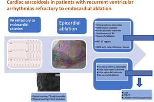 Cardiac sarcoidosis in patients with recurrent ventricular arrhythmias refractory to endocardial ablation.