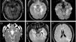 Type 2 herpes simplex virus-induced anti-N-methyl-D-aspartate receptor encephalitis responsive to immunoglobulin monotherapy.