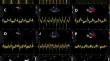 Echocardiographic assessment of left atrial appendage morphology and function-an expert proposal by the German Working Group of Cardiovascular Ultrasound.