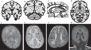 Effects of early parenteral nutrition on the development of premature infants born at 22–23 weeks of gestation: a retrospective cohort study evaluated by brain magnetic resonance imaging