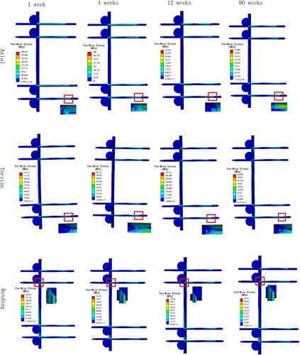 How Does the Stress in the Fixation Device Change during Different Stages of Bone Healing in the Treatment of Fractures? A Finite Element Study of External Fixation for Tibial Fractures.