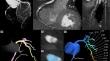 Changes in donor vessel physiology following coronary computed tomography angiography guided chronic total occlusion percutaneous coronary intervention: insights from computed tomography fractional flow reserve and artificial intelligence-guided ischemia model.