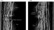 Evaluation under loading detects medial meniscus extrusion in patients with reconstructed anterior cruciate ligament and restricted knee extension.