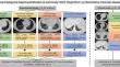 Artificial intelligence-based quantification of pulmonary HRCT (AIqpHRCT) for the evaluation of interstitial lung disease in patients with inflammatory rheumatic diseases.