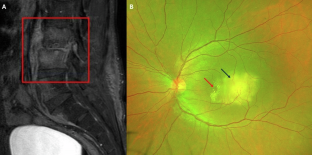 Tubercular choroidal granuloma development despite anti-tubercular treatment: managed with anti-VEGF and oral steroids.