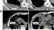 Prophylactic effect of tissue flap in the prevention of bronchopleural fistula after surgery for lung cancer.