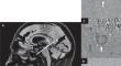 Assessment of neurofluid dynamics in relation to clinical improvement after tap-test: pilot study.