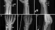 Improved Automated Quality Control of Skeletal Wrist Radiographs Using Deep Multitask Learning.