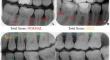 Deep Convolutional Neural Network for Automated Staging of Periodontal Bone Loss Severity on Bite-wing Radiographs: An Eigen-CAM Explainability Mapping Approach.