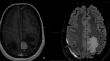 Predictive value of perilesional edema volume in melanoma brain metastasis response to stereotactic radiosurgery