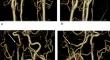 Aberrant course of the right petrous internal carotid artery (ICA) associated with right type 1 proatlantal artery and bilateral occipital arteries arising from the ICA diagnosed by computed tomography angiography.