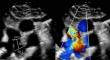 Transcatheter Patent Ductus Arteriosus Closure in Premature Infants: Comparison of Echocardiogram and Angiogram Measurements.