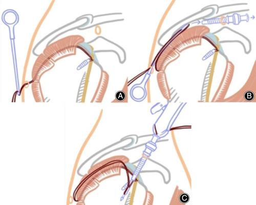 Clinical Outcome of an All Arthroscopic 'Whole Layer' Rotator Cuff Repair Technique with Simultaneous Biceps Tenodesis.