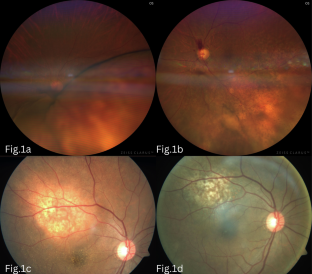 Choroidal metastases secondary to lung carcinoma: photo essay.