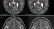 Incidental brain tumor findings in children: prevalence, natural history, management, controversies, challenges, and dilemmas.