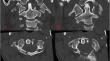 Isolated C1 arch fractures: C1-2 fusion vs. C1 osteosynthesis - surgical strategies for potentially unstable injuries.