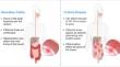 MicroRNA signatures in the pathogenesis and therapy of inflammatory bowel disease