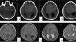 Malignant meningioma of the falx cerebri in a child: case report and literature review.