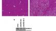 NORE1A loss promotes MASLD/MASH