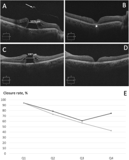 Macular holes with minimal diameter greater than 650 µm close in 85% of cases after vitrectomy and ILM peeling with visual benefit