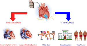 Mid-term clinical outcomes and cardiac function in patients receiving cardiac contractility modulation.