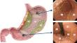 Classification of fundic gland polyps for predicting gastric neoplasms in Helicobacter pylori-negative patients with familial adenomatous polyposis.