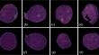 Acute lymphoblastic leukemia classification using persistent homology