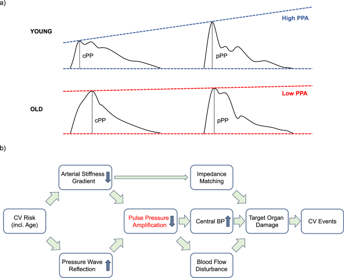 Pulse pressure amplification as a hemodynamic predictor of cardiovascular disease