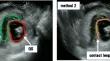 Quantification of the size of subchorionic hematoma causing pregnancy-related complications: a retrospective cohort study.