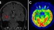 Simultaneous <sup>18</sup>F-FDG PET/MRI predicting favourable surgical outcome in refractory epilepsy patients.